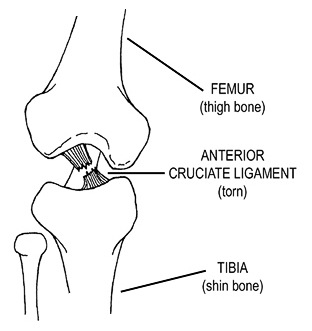 Anterior Cruciate Ligament